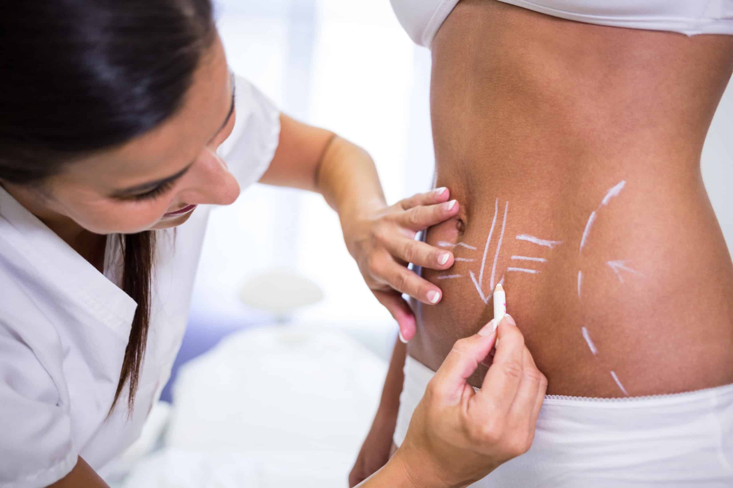 surgeon drawing lines on womans abdomen for liposuction and cellulite removal scaled 1